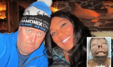 Yababariye umugabo we wamutwikishije lisansi