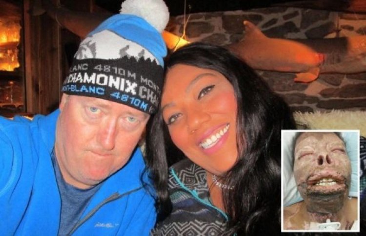 Yababariye umugabo we wamutwikishije lisansi