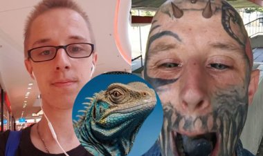 Akomeje kuvugisha benshi nyuma yo kwibagisha ngo ase n'umuserebanya