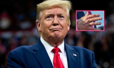 Perezida Donald Trump akomeje kuzongwa n'uburwayi bukomeye bw'imitsi 