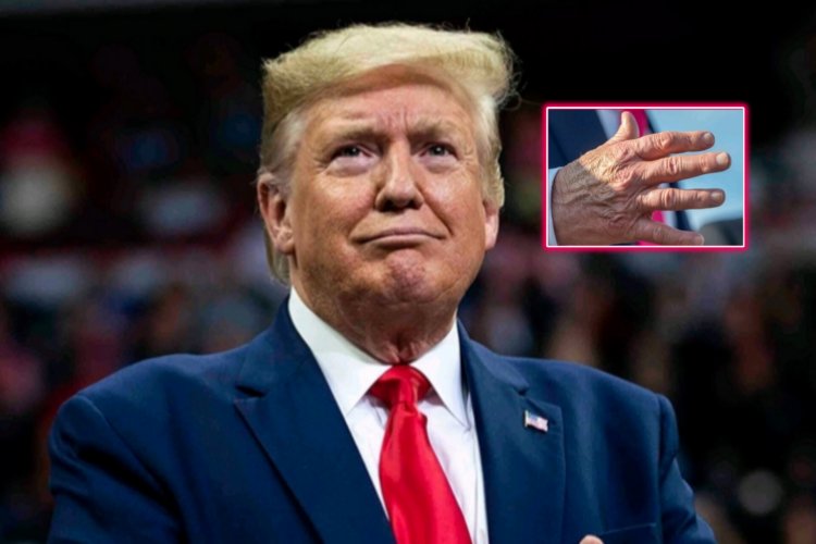 Perezida Donald Trump akomeje kuzongwa n'uburwayi bukomeye bw'imitsi 